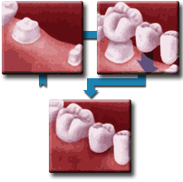 Dental Bridge