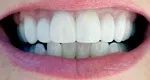 After Dental Veneers