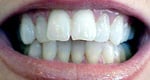Before Dental Veneers